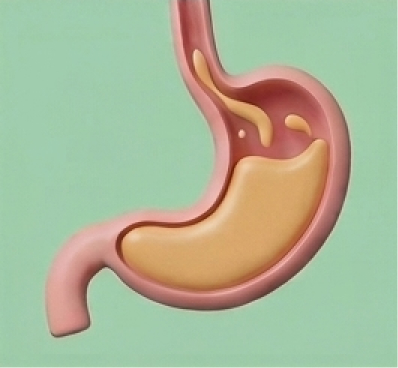 Ícone Refluxo<br />
gastroesofágico